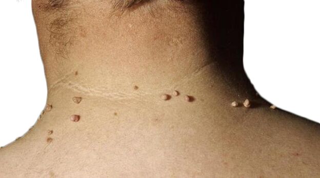 Papillomas on the neck - a consequence of the defeat of the virus