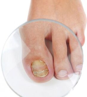 Fungus nail