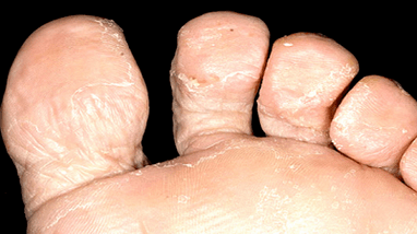 How to recognize the presence of a mushroom between toes