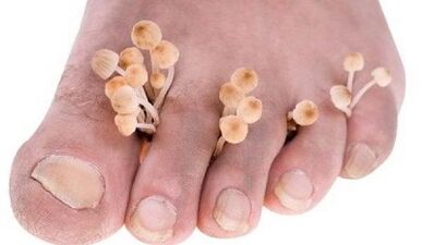 Reasons for the development of fungus between toes