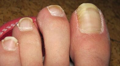 As the nail fungus manifests