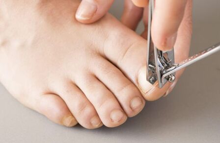 Causes of nail fungus