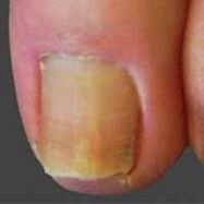 nail infection with dermatophytes