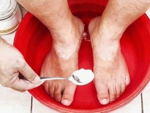 soda baths for fungus