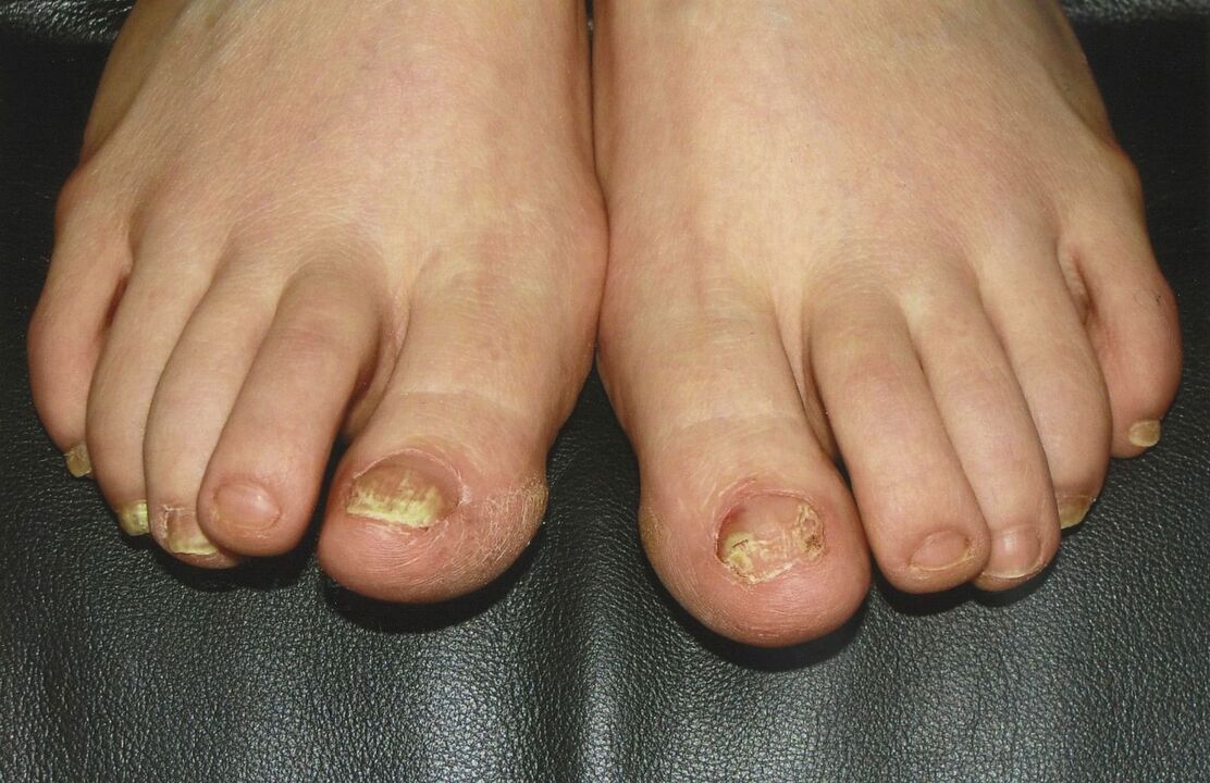 how to treat nail fungus with nail polish