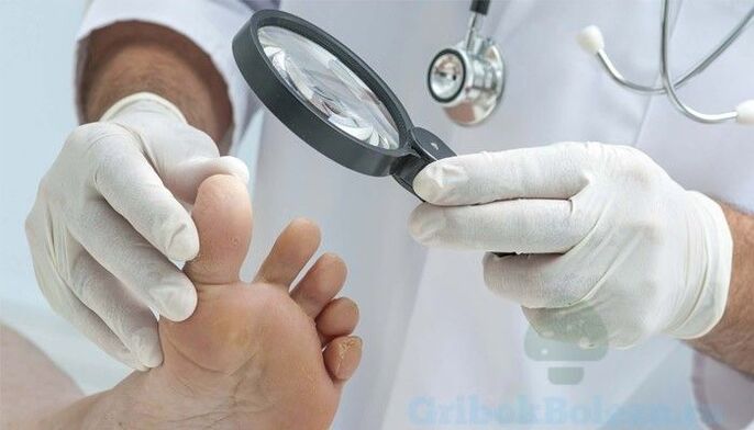 doctor's diagnosis of foot fungus