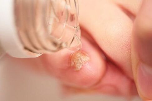 apple cider vinegar for nail fungus