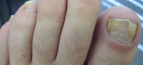 symptoms of nail fungus and their treatment with vinegar