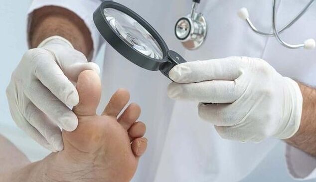 Diagnosis of fungi