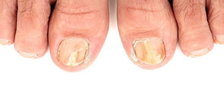 nail plate fungal damage