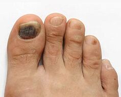 Manifestations of toenail fungus