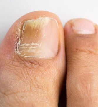 Toenail fungus, which occurs against a background of weak immunity