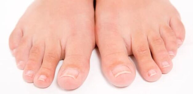 Toes with nail fungus
