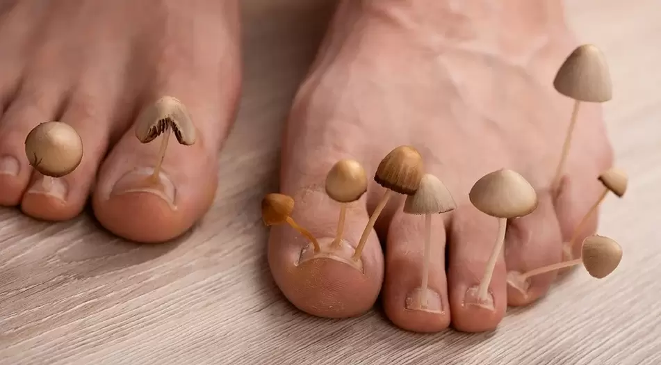 A fungal infection affecting the toenails