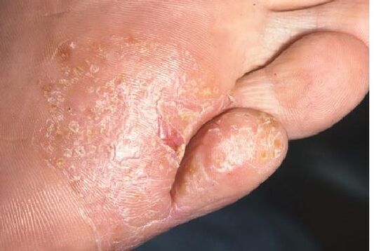 Manifestations of fungal infection on the skin of the feet