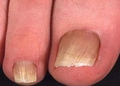 Fungi for nails on the legs of the initial phase