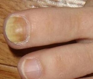 Symptoms of the initial phase fungus nails